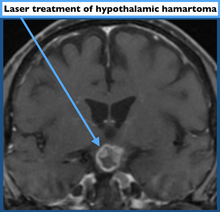 Laser treatment of hypothalamic harmartoma